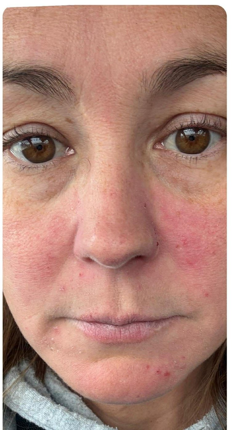 After using North Glow