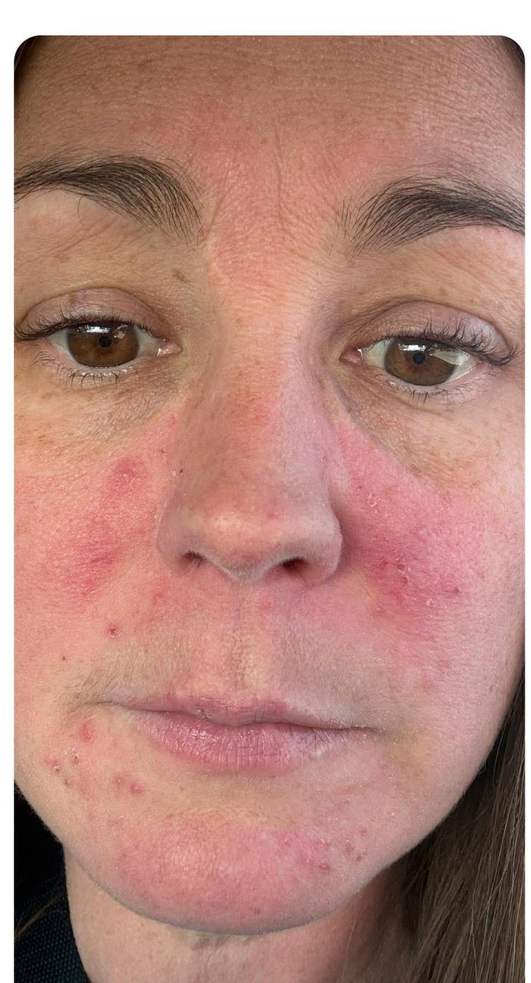 Before using North Glow